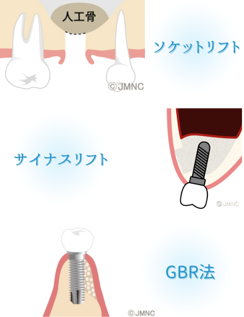 骨造成により骨量不足にも対応可能