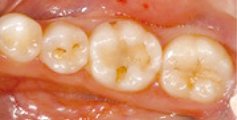 虫歯の治療前1