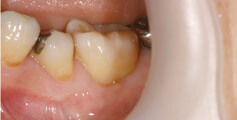 歯周外科の治療後1