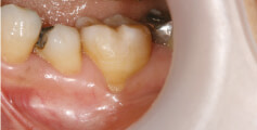 歯周外科の治療前1