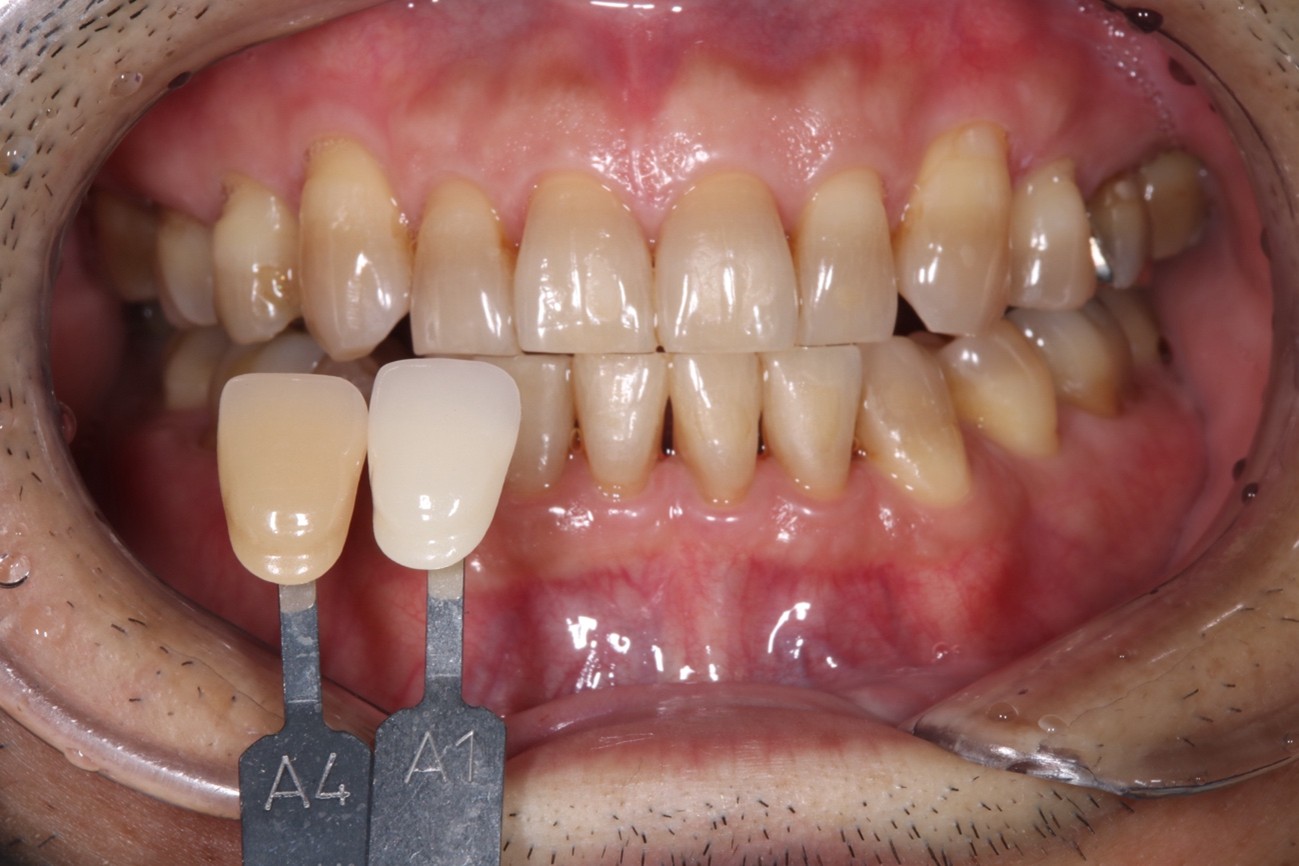 ホワイトニング治療前